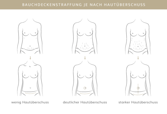 Bauchdeckenstraffung, Plastische & Ästhetische Chirurgie in Stuttgart, Dr. Schumacher