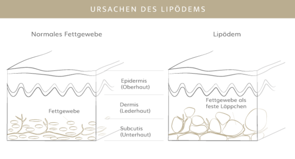 Ursachen Lipödem, Plastische & Ästhetische Chirurgie in Stuttgart, Dr. Schumacher