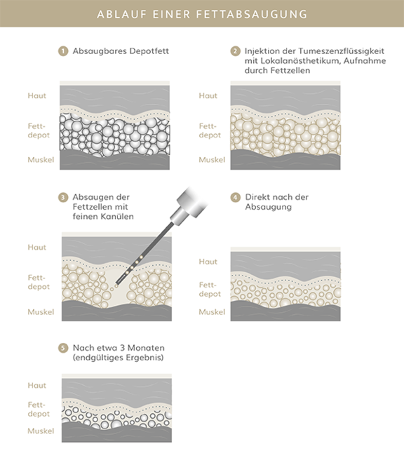 Ablauf Fettabsaugung, Plastische & Ästhetische Chirurgie in Stuttgart, Dr. Schumacher