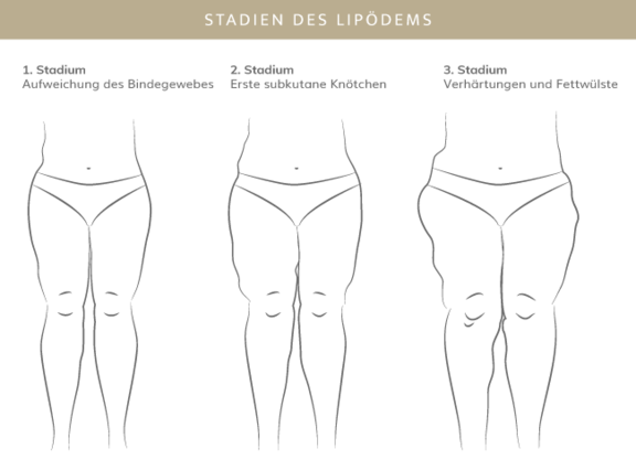 Stadien Lipödem, Plastische & Ästhetische Chirurgie in Stuttgart, Dr. Schumacher