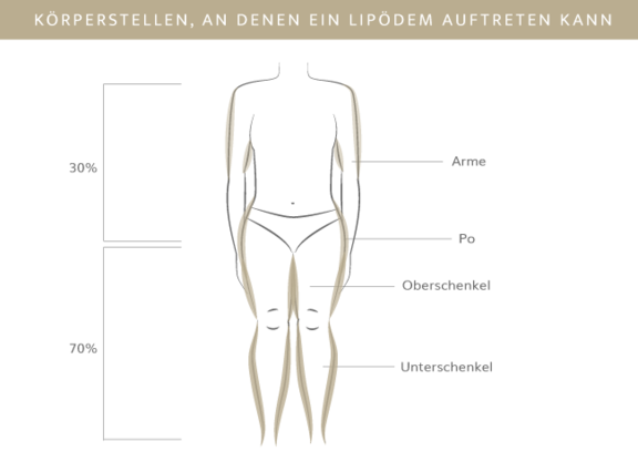 Körperstellen Lipödem, Plastische & Ästhetische Chirurgie in Stuttgart, Dr. Schumacher